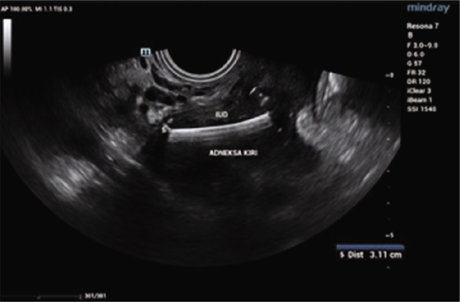Ultrasound showing the intrauterine devices at the left adnexa.