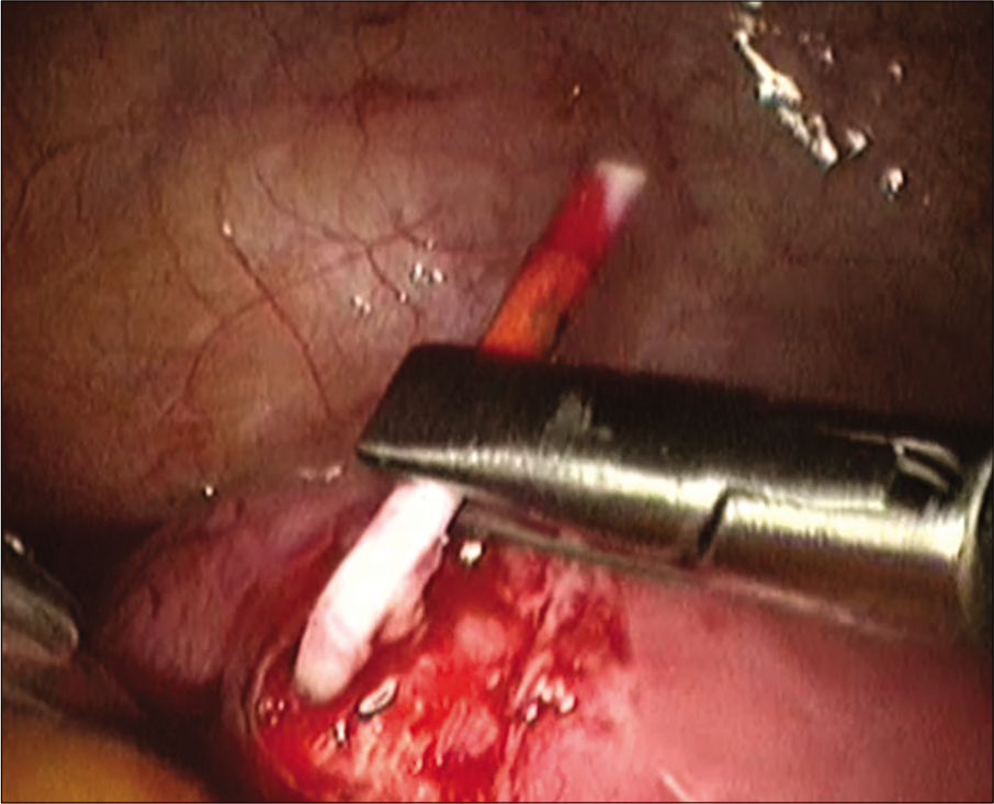 Intrauterine devices removal on laparoscopic view.