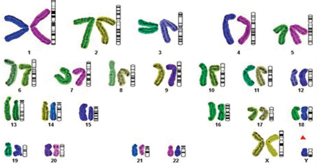 Representative karyotype (whole chromosome painting) showing the 47, XXY chromosome compliments with differentiating pairing between homozygous and non-homozygous using different color codes with the build software Cytoscan system from Olympus (Japan).