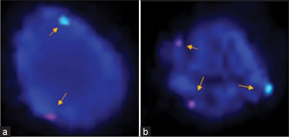 (a and b) In prophase, fluorescence in situ hybridization (FISH) analysis is showing the identification of sex chromosomes (X and Y) after using specific probes, for the identification of X (green signal) and Y (orange signal) chromosome using Vysis probe (CEP X (DXZ1) (Xp11.1-Xq11.1) Spectrum Green/LSI SRY (Yp11.3) Spectrum Orange, nuclei were counter stained with DAPI (blue). Representative images showing the presence of karyotype XYY in the case of azoospermia. FISH analysis showing X and Y chromosomes (normal a) and an extra copy of the Y-chromosome in prophase (b) showing two red nuclei (arrow) in another case of azoospermia to confirm rare category of Klinefelter’s syndrome.