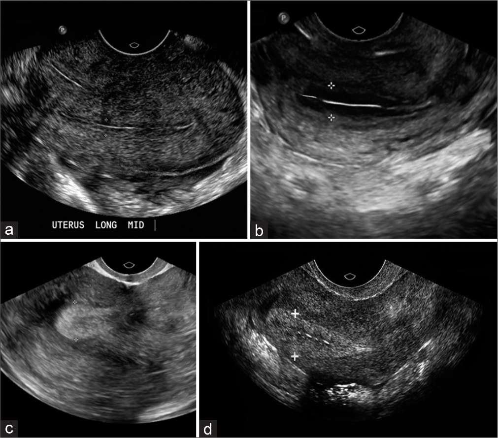 Ultrasonography in patients during the in vitro fertilization cycle. (a) Thin endometrial thickness (ET) below 6 mm on the day of progesterone administration in conventional treatment/IVF cycle. (b) Improvement in endometrial thickness after first infusion of platelet-rich plasma (PRP) (≥7 mm before progesterone). (c) ET after the second infusion of PRP (≥7 mm before progesterone). (d) Endometrial thickness after the third PRP infusion reached 7 mm on day 5 before progesterone administration.
