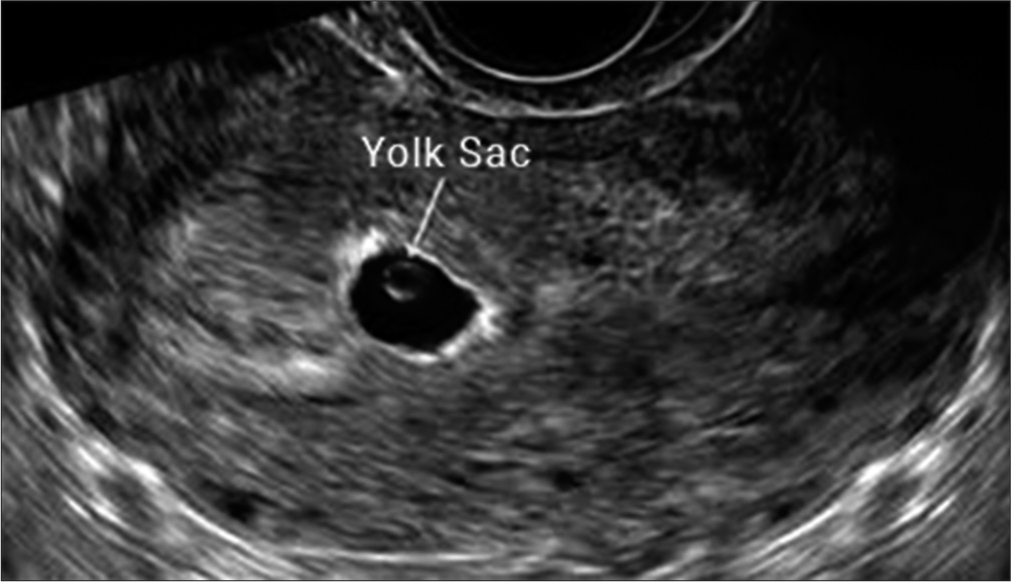 Intrauterine gestational sac at approximately 6 weeks (transvaginal ultrasonography).